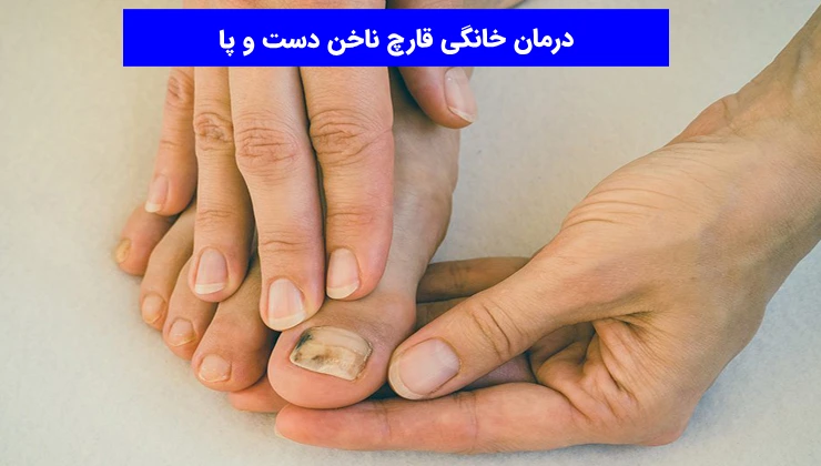 درمان خانگی قارچ ناخن دست و پا